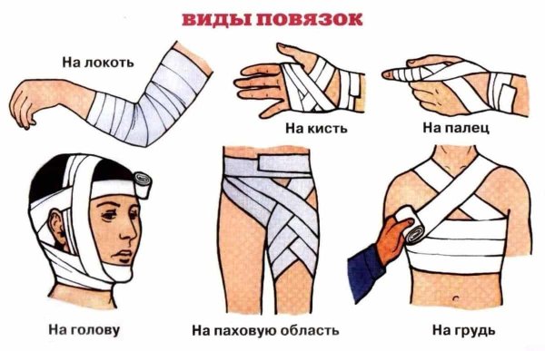 Техника наложения колосовидной повязки на плечо