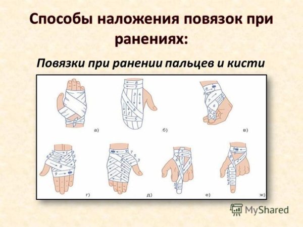 Наложение повязки на кисть