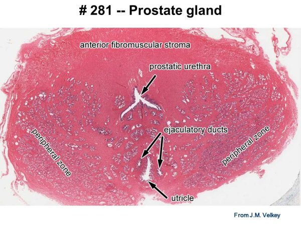 Узловая гиперплазия предстательной железы микропрепарат