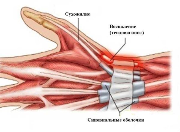 Тендовагинит сухожилий кисти мкб