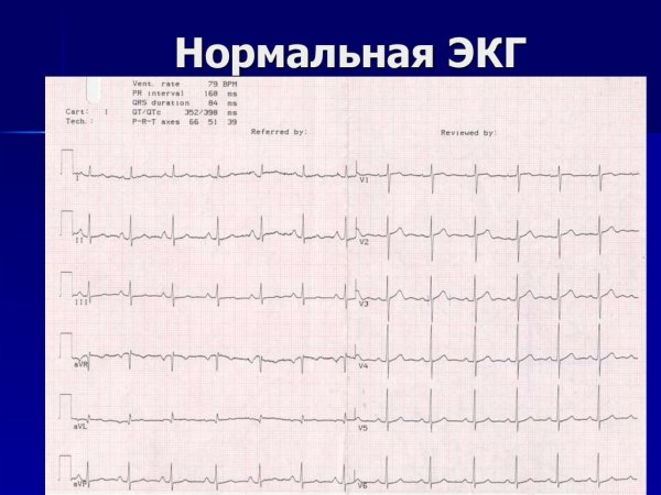 Норма ЭКГ во всех отведениях