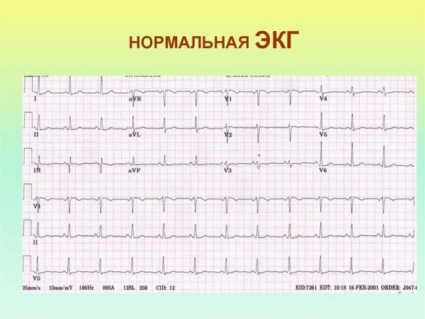 Нормальная ЭКГ 1 отведение