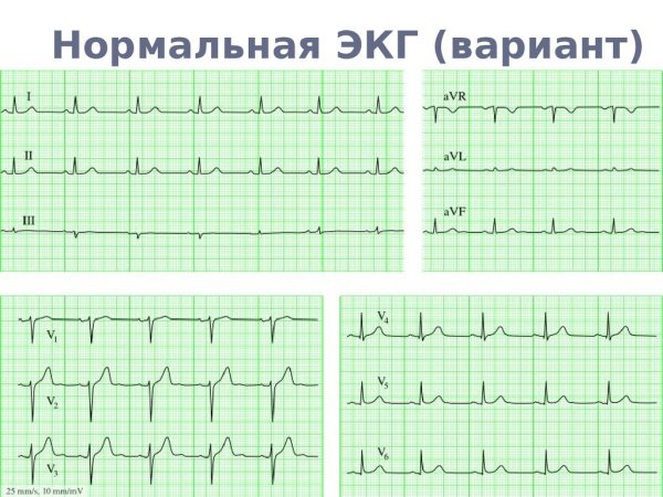 3 Стандартное отведение ЭКГ норма
