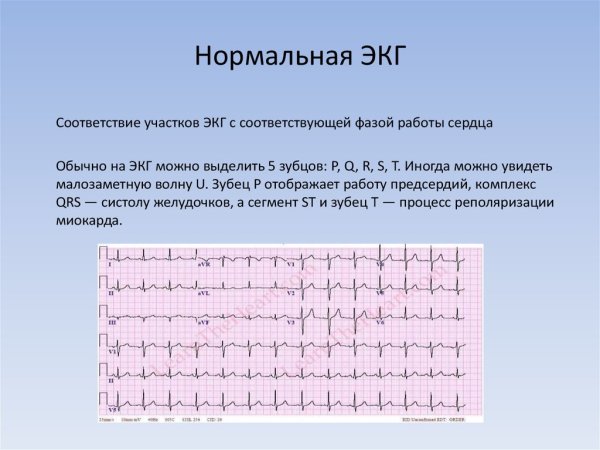 Нормальная ЭКГ во всех отведениях 50мм