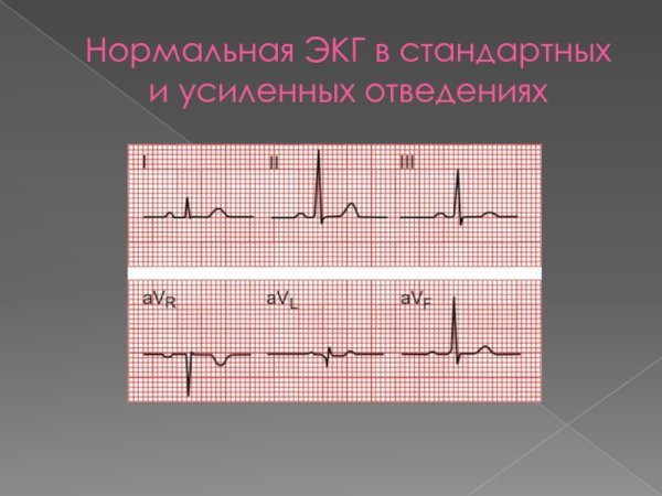 Пример нормальной ЭКГ С расшифровкой