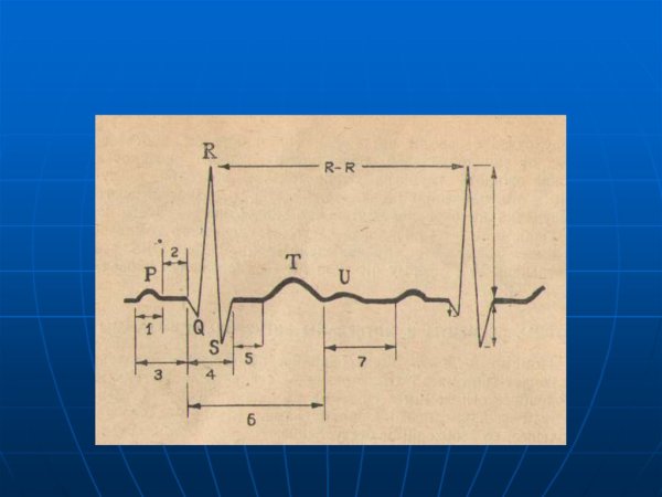 ЭКГ RR 952 МС