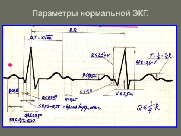 ЭКГ патологии расшифровка