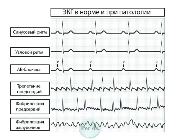 Нормы зубцов и интервалов ЭКГ