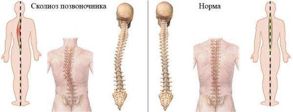 Сколиотическая деформации позвоночника 1-2 степени