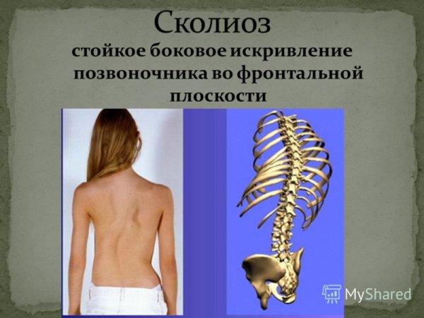 Искривление позвоночника