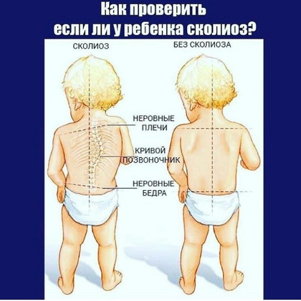 Врожденное искривление позвоночника