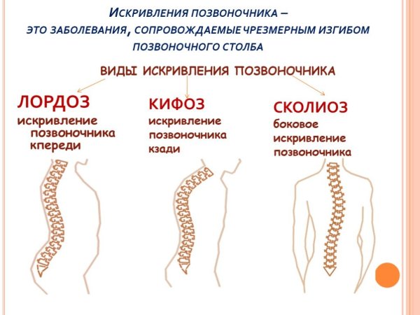 Деформации позвоночника ( сколиоз, лордоз, гиперкифоз)