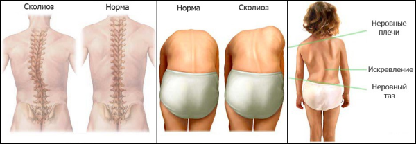 Формы искривления сколиоза