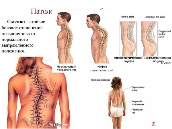 Деформации позвоночника ( сколиоз, лордоз, гиперкифоз)