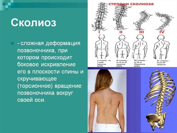 S образный сколиоз