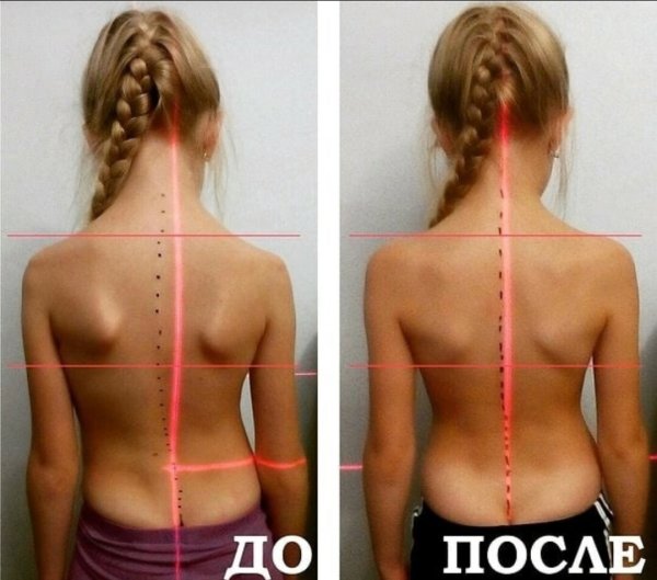 Исправление искривления позвоночника