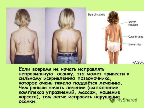 Исправление сколиоза у детей