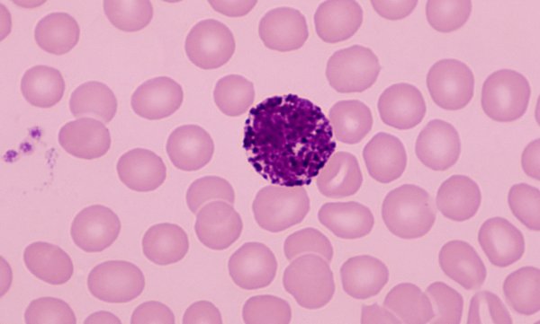 Базофильный лейкоцитоз