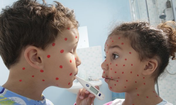 Вирусная инфекция ветрянка