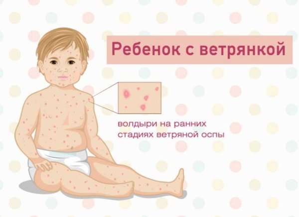 Ветряная оспа у детей сыпь