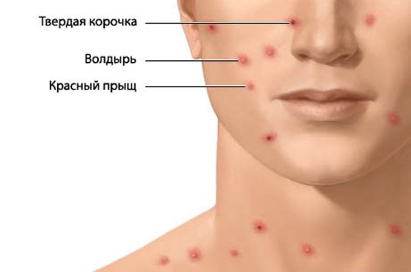 Гангренозная ветрянка