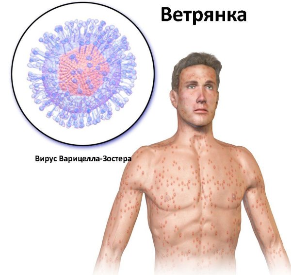 Ветряная оспа осложненная