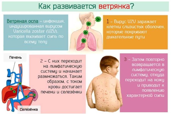 Ветрянка у детей картинки