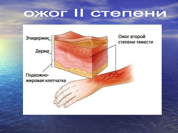 Степени ожогов термические 1 степень