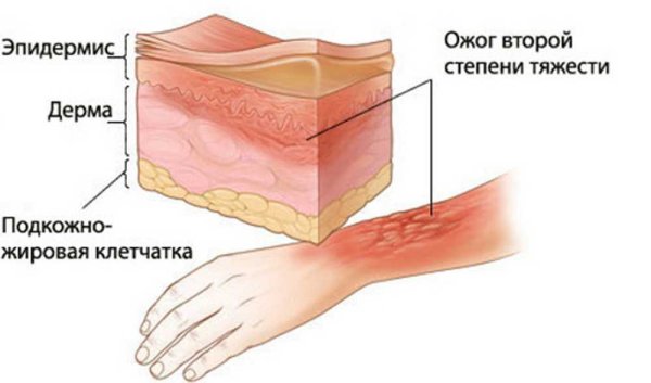 Ожог первой степени характеризуется