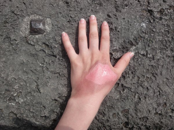 Сильнейший Солнечный ожог