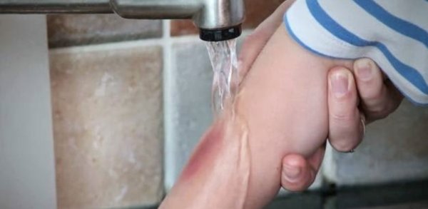 Химический ожог на запястье