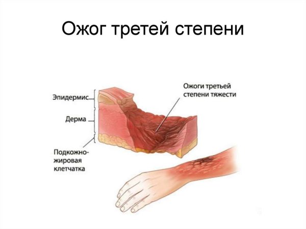 Безопасность детства ожоги