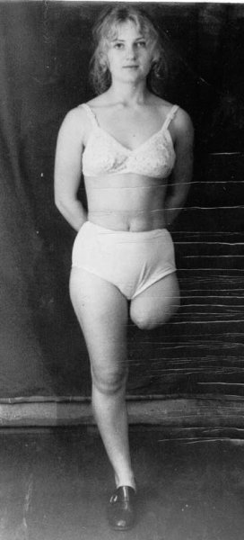 Аделаида Бестужева в ампути