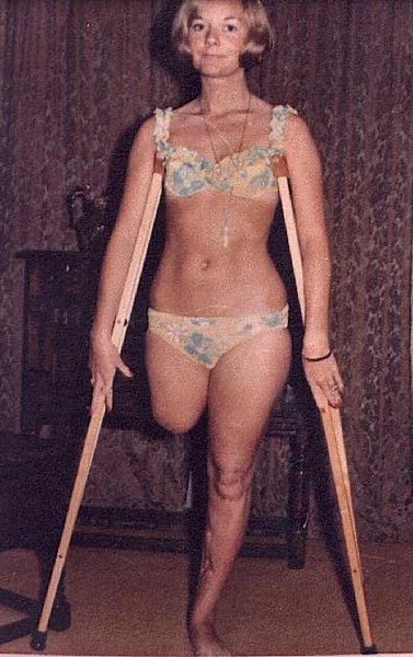 Ампути женщины в изобразительном искусстве