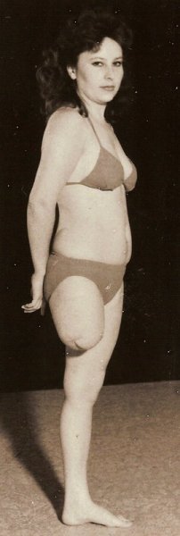 Ампути Диана Тюрина Питер