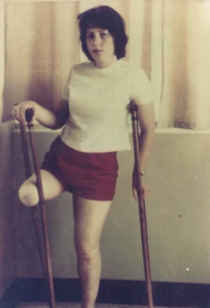 Женщины с ампутацией бедра