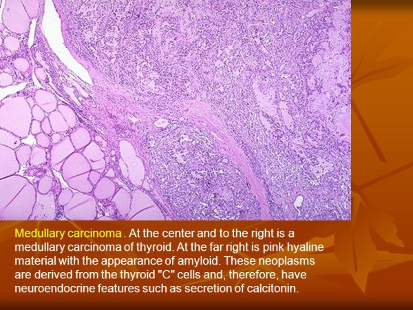 Медулярныйрак щитовидной железы гистология