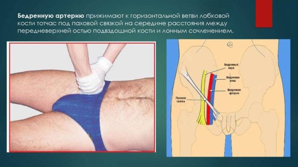 Ушивание бедренной артерии