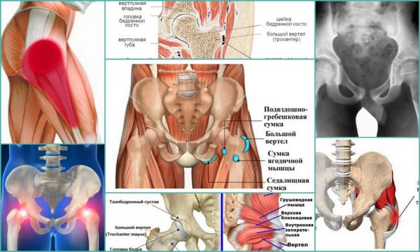 Трохантерита тазобедренного сустава симптомы