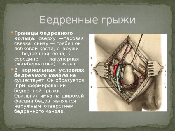Бедренные грыжи топографическая анатомия