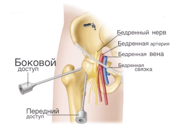 Пункция тазобедренного сустава техника