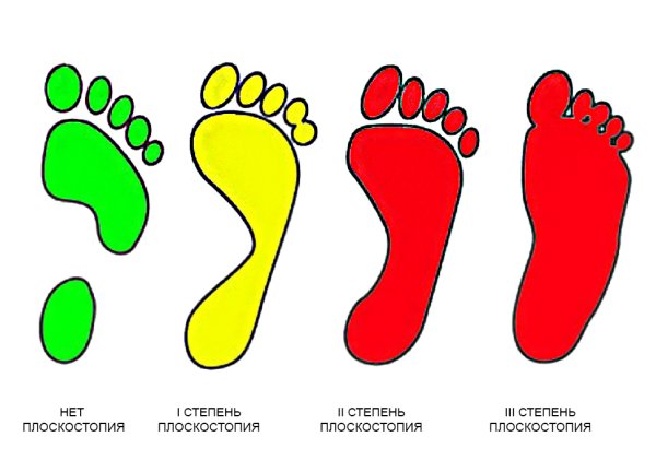 Плоскостопие 1 2 3 степени