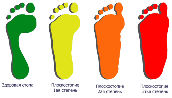 Продольное плоскостопие 1 степени