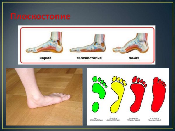 Степени плоскостопия вид сбоку
