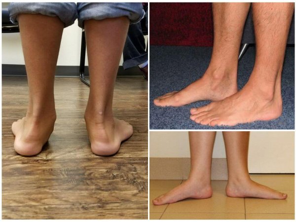 Плоскостопие деформация стопы