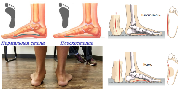 Плоскостопие вид сзади