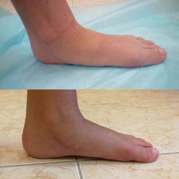 Продольное и поперечное плоскостопие