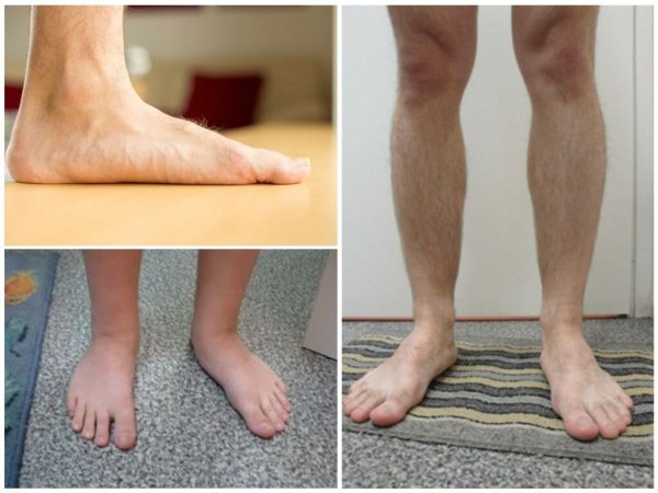 Паралитическое плоскостопие