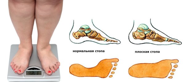 Стопа плоскостопие