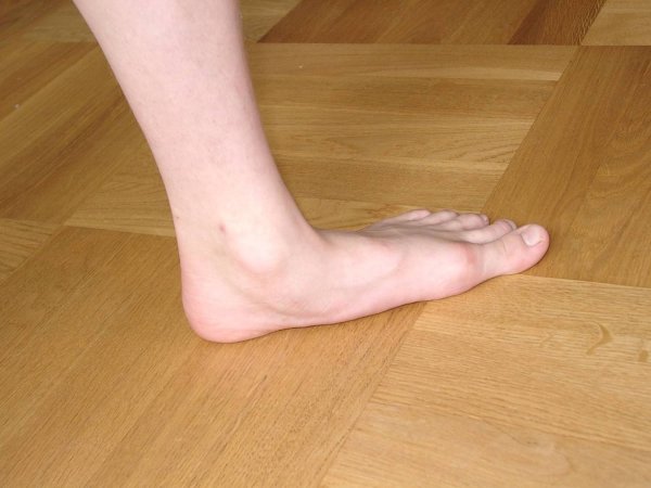 Продольное плоскостопие 3 степени